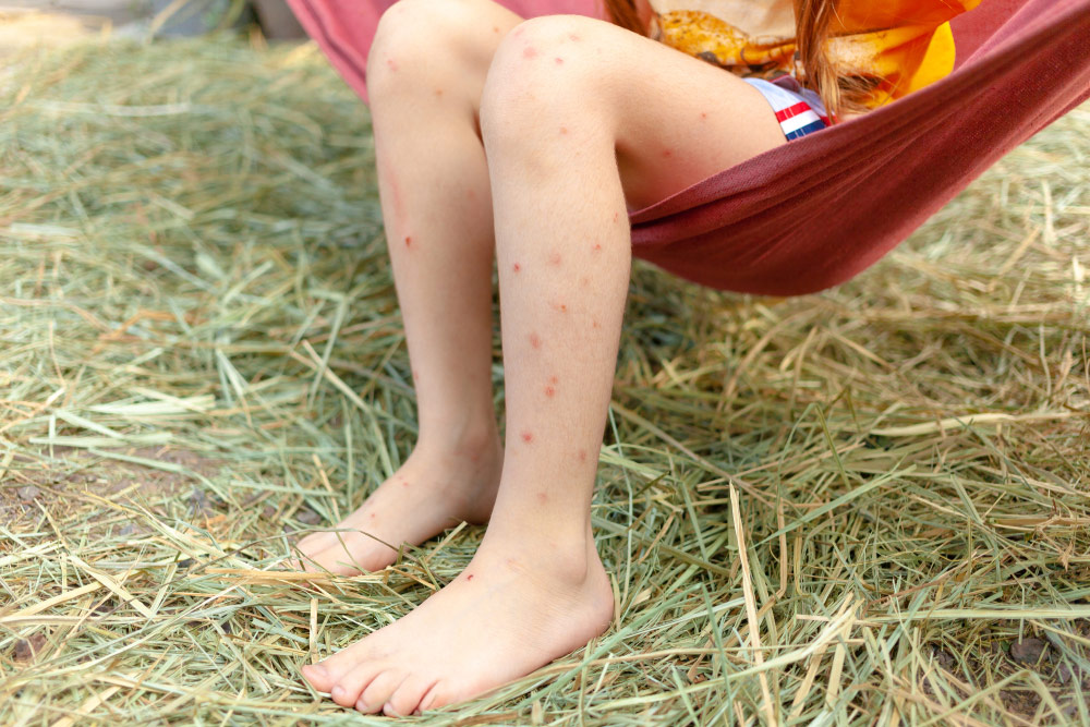 Child with bug bites